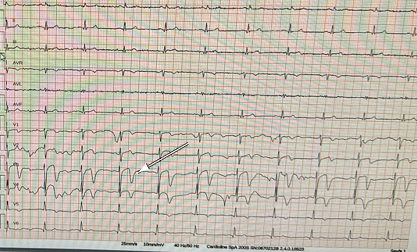 Ağrısız dönemde çekilen başvuru EKG’si. V2–V3’te pozitif-negatif bifazik T dalgaları ve V4–V5’e uzanan derin T dalga inversiyonları (ok, V3); korunmuş R progresyonu ve belirgin ST elevasyonunun olmaması ile Wellens paterni.